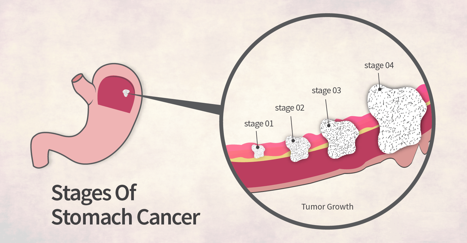 Stomach Cancer Treatment In Punjab Stomach Cancer Treatment Cost In 